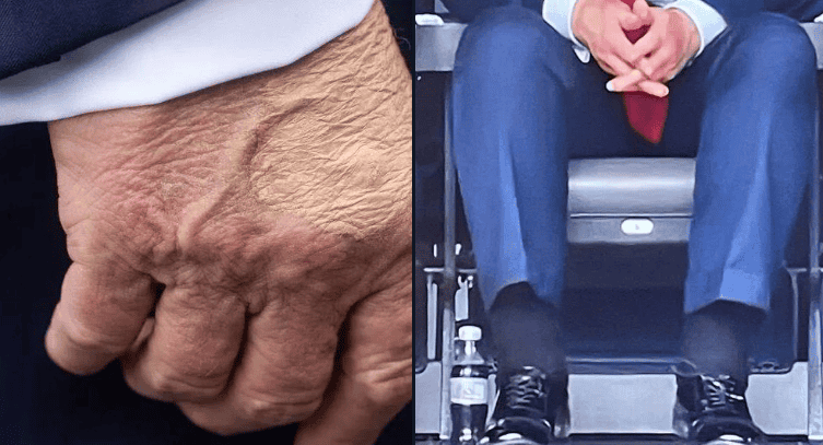 Close-up of Donald Trump's swollen hands and ankles, wearing compression socks during a public appearance in 2025.