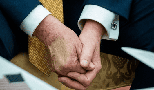 Close-up of Donald Trump’s hands showing discoloration and swelling, fueling speculation about possible chronic venous insufficiency or circulatory health issues.